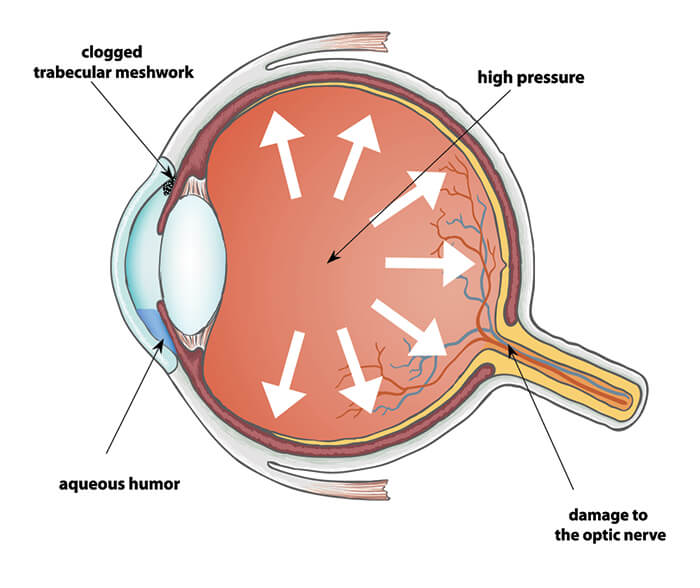 Diagram of glaucoma causes