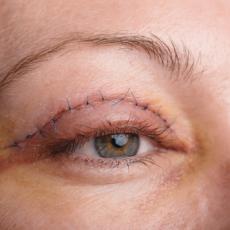 Image of Woman's Eye with Stitches from Eyelid Surgery