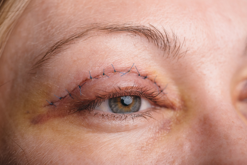 Image of Woman's Eye with Stitches from Eyelid Surgery