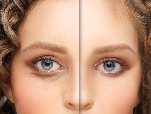 Image of woman with before and after images of blepharoplasty surgery.
