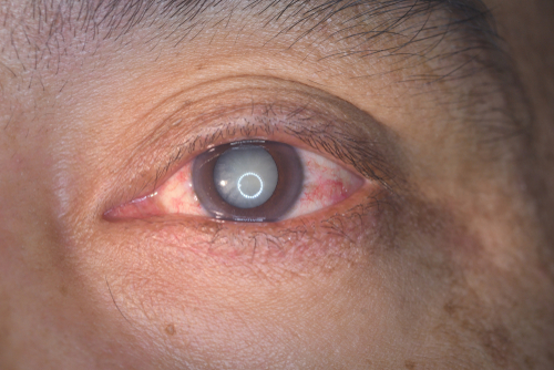 Close up of a senile cataract during eye examination.