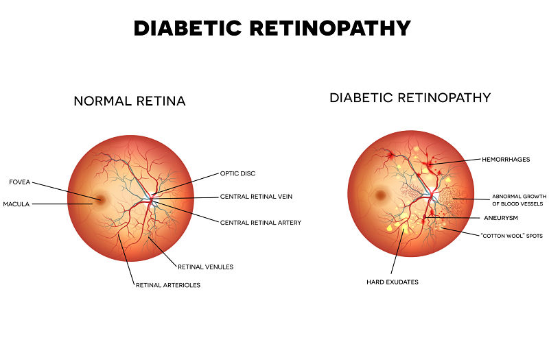 diabetc-retinopathy_opt.jpg