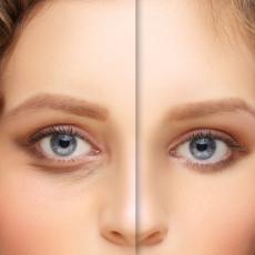 Image of woman with before and after images of blepharoplasty surgery.