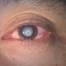 Close up of a senile cataract during eye examination.