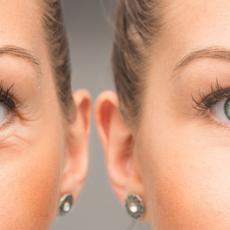 Eyes of woman with and without eye bag before and after cosmetic treatment.
