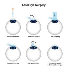 Images displaying a visual for How Much Does LASIK Cost in 2025 and the process of LASIK eye surgery