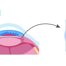 Illustration showing 1 human eye and 1 ICL implant and where it is placed. 